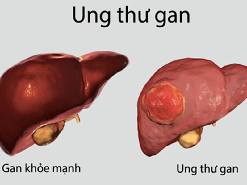 Cơn đau dạ dày có đặc điểm này cảnh báo không lành, khuyên mọi người đi khám ngay để tránh 7 bệnh ung thư nguy hiểm- Ảnh 2.