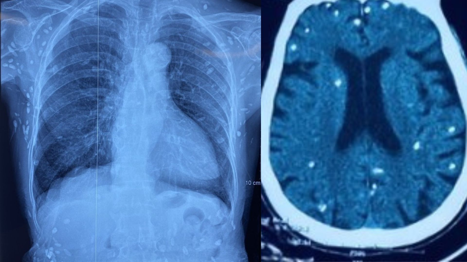 Ung thư 'gõ cửa' sau nhiều năm duy trì 2 thói xấu- Ảnh 2.