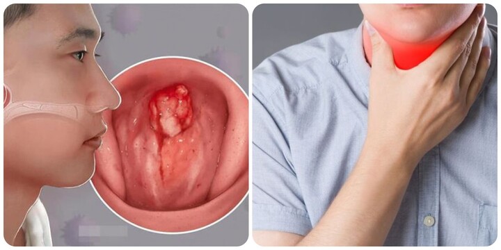 9 Dấu Hiệu Ung Thư Vòm Họng Giai Đoạn Đầu- Ảnh 1. 9 Dấu Hiệu Ung Thư Vòm Họng Giai Đoạn Đầu- Ảnh 1.