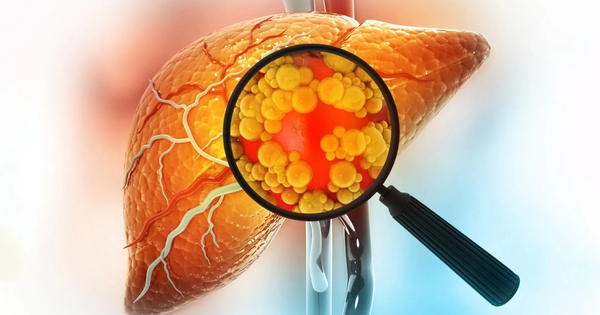 Tiêu thụ quá nhiều 2 đồ uống này, đừng trách vì sao gan ngập trong mỡ: Nghiên cứu mới đưa ra bằng chứng- Ảnh 1. Tiêu thụ quá nhiều 2 đồ uống này, đừng trách vì sao gan ngập trong mỡ: Nghiên cứu mới đưa ra bằng chứng- Ảnh 1.