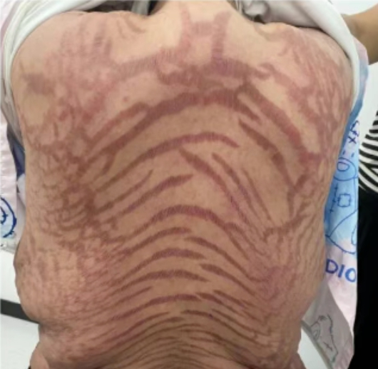 Người phụ nữ suy tuyến thượng thận, toàn thân nổi vân đỏ: Bác sĩ nói “do dùng thứ này 10 năm”- Ảnh 1. Người phụ nữ suy tuyến thượng thận, toàn thân nổi vân đỏ: Bác sĩ nói “do dùng thứ này 10 năm”- Ảnh 1.
