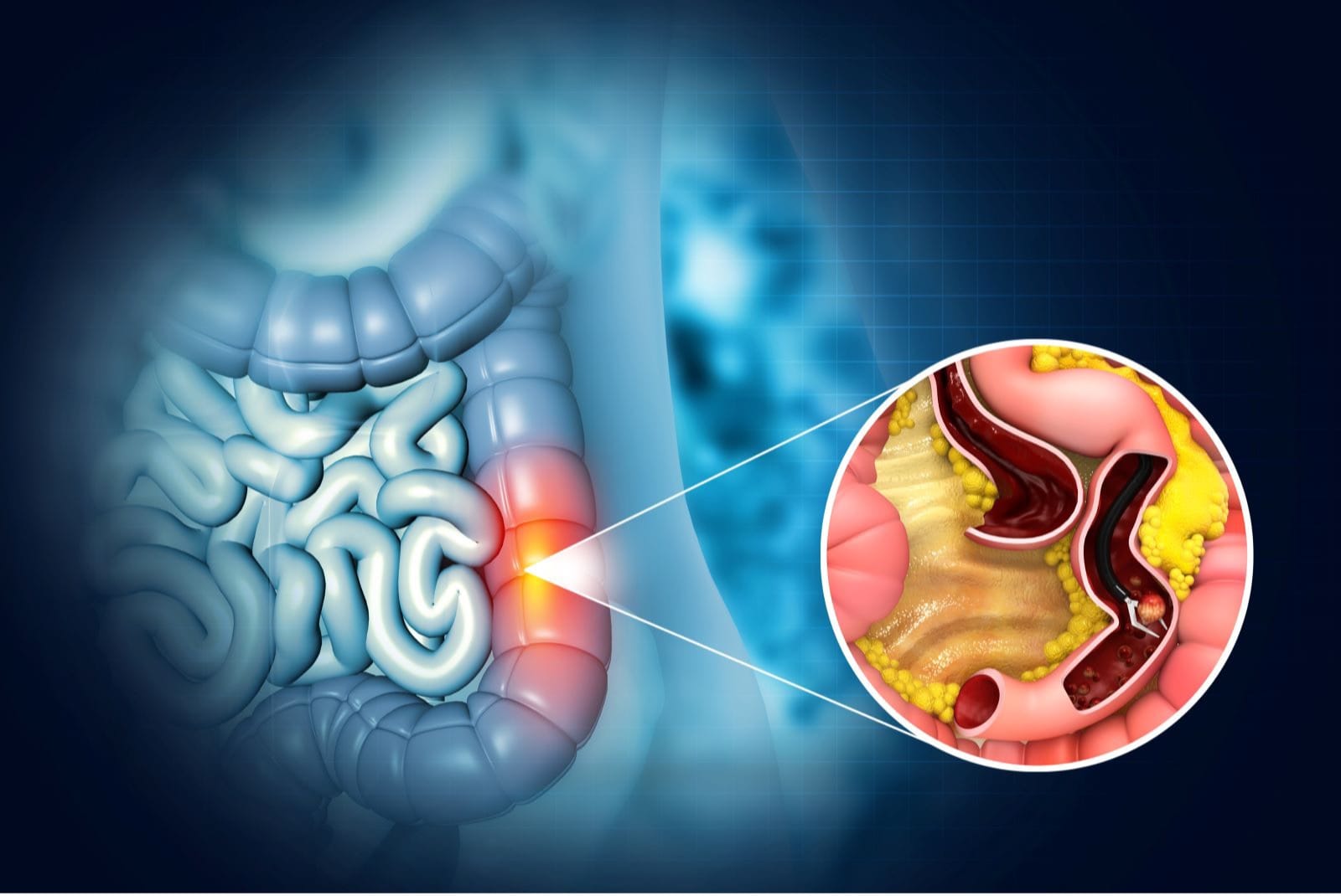 Ung thư đại tràng thường ‘rình rập’ những người có đặc điểm này trên cơ thể
