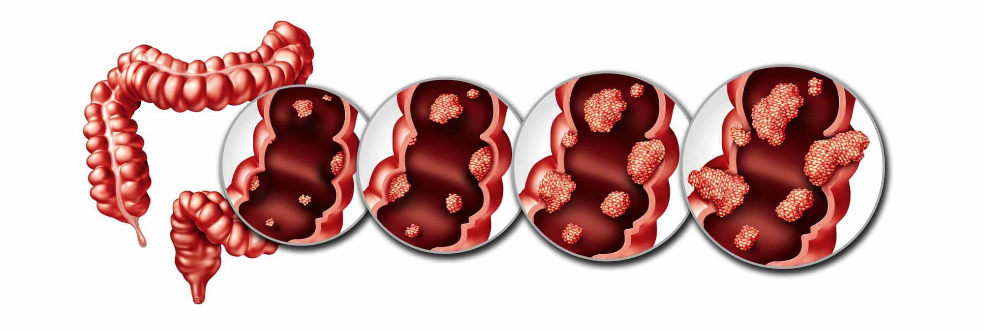 Ung thư đại tràng thường ‘rình rập’ những người có đặc điểm này trên cơ thể- Ảnh 1.