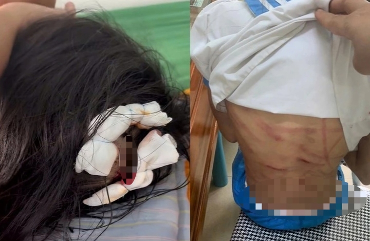 Xác minh vụ bé gái lớp 5 nghi bị cha dượng bạo hành dã man- Ảnh 1. Xác minh vụ bé gái lớp 5 nghi bị cha dượng bạo hành dã man- Ảnh 1.
