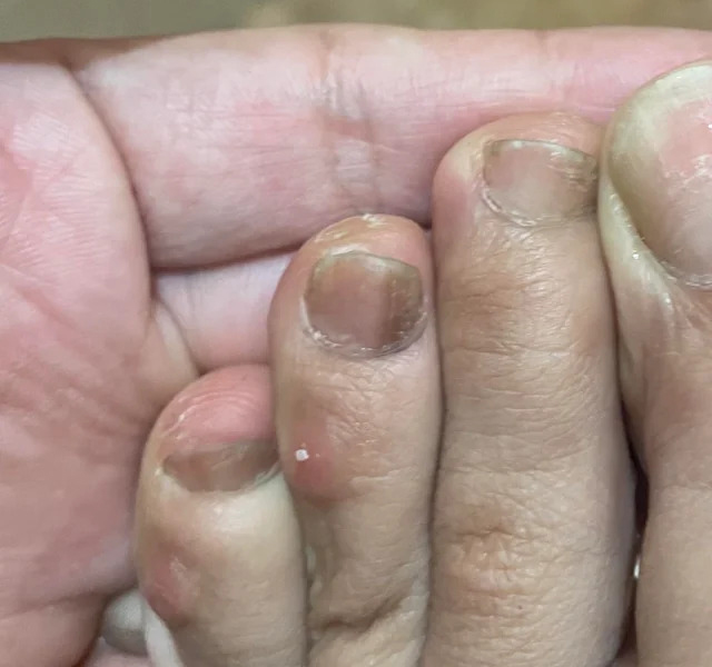 B&agrave;n ch&acirc;n của người "giấu" ung thư thường c&oacute; 5 kh&aacute;c biệt, chỉ mong bạn kh&ocirc;ng đen đủi c&oacute; c&aacute;i n&agrave;o!- Ảnh 3.