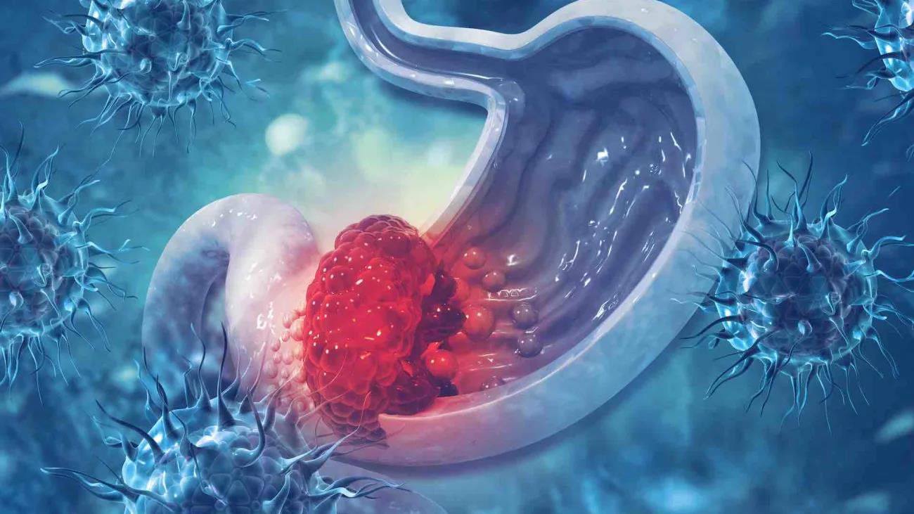 Mới 35 tuổi đã mắc ung thư giai đoạn cuối: Bác sĩ chỉ ra “thủ phạm”, không phải hút thuốc hay uống rượu- Ảnh 2.