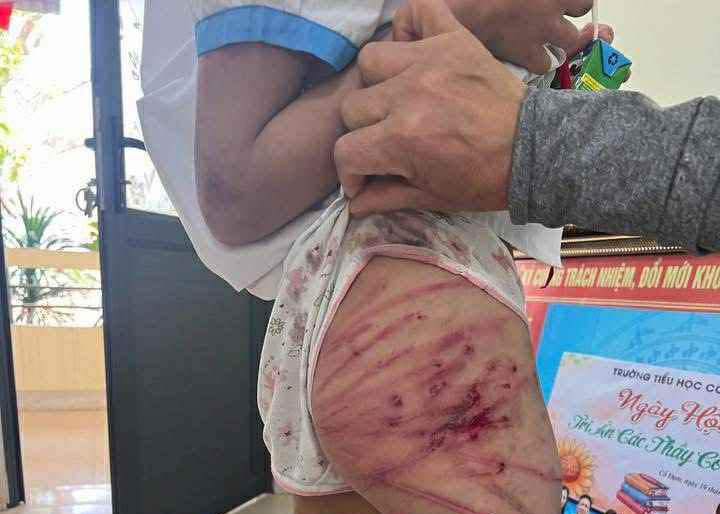 Vụ bé gái lớp 5 bị bạo hành ở Hà Tĩnh: Công an triệu tập cha dượng- Ảnh 1.