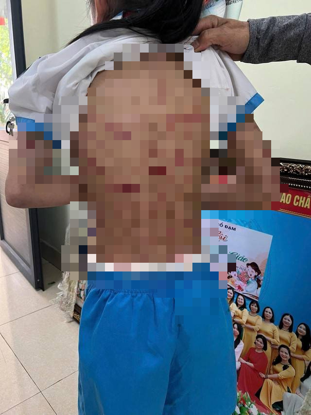 Nguyễn Văn Nam, gã cha dượng đánh đập tàn bạo bé gái lớp 5, đối diện với hình phạt gì?- Ảnh 2. Nguyễn Văn Nam, gã cha dượng đánh đập tàn bạo bé gái lớp 5, đối diện với hình phạt gì?- Ảnh 2.
