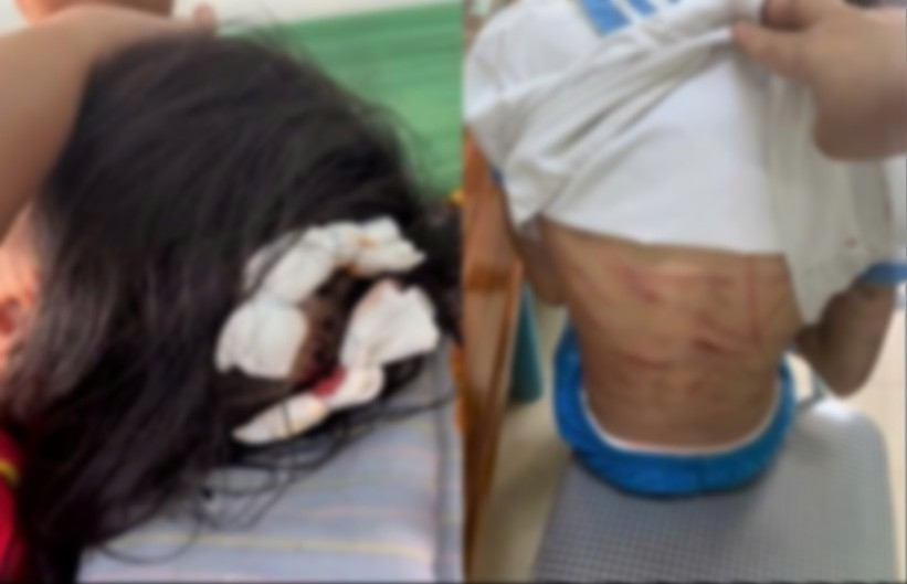 Tình trạng sức khỏe bé gái 9 tuổi bị cha dượng dùng búa đinh đánh vào đầu- Ảnh 3. Tình trạng sức khỏe bé gái 9 tuổi bị cha dượng dùng búa đinh đánh vào đầu- Ảnh 3.