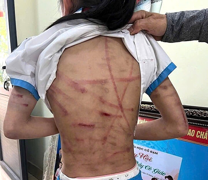 Bé gái lớp 5 ở Hà Tĩnh bị cha dượng bạo hành dã man: Đây không phải lần đầu- Ảnh 3. Bé gái lớp 5 ở Hà Tĩnh bị cha dượng bạo hành dã man: Đây không phải lần đầu- Ảnh 3.