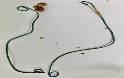 Cô gái 29 tuổi "bỏ quên" dụng cụ y tế trong bụng 1 năm rưỡi- Ảnh 1. Cô gái 29 tuổi "bỏ quên" dụng cụ y tế trong bụng 1 năm rưỡi- Ảnh 1.