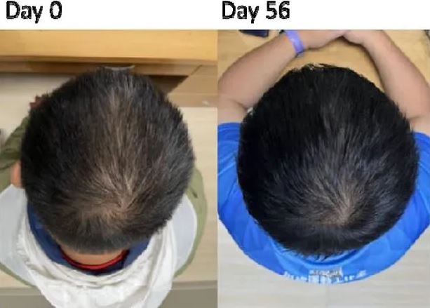 Tìm ra phương pháp chữa hói đầu, kích thích mọc tóc cực tốt – sau 8 tuần là cải thiện rõ- Ảnh 1. Tìm ra phương pháp chữa hói đầu, kích thích mọc tóc cực tốt – sau 8 tuần là cải thiện rõ- Ảnh 1.