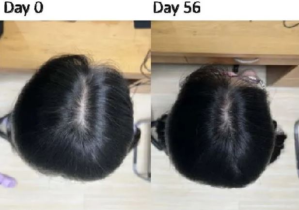 Tìm ra phương pháp chữa hói đầu, kích thích mọc tóc cực tốt – sau 8 tuần là cải thiện rõ- Ảnh 2. Tìm ra phương pháp chữa hói đầu, kích thích mọc tóc cực tốt – sau 8 tuần là cải thiện rõ- Ảnh 2.