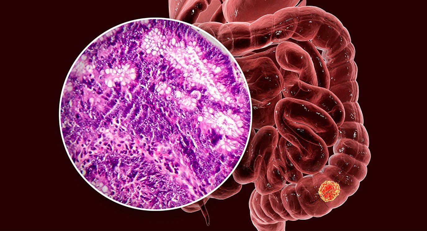 Đau nhói ở 2 chỗ này, cẩn thận kẻo ung thư đại tràng đã 