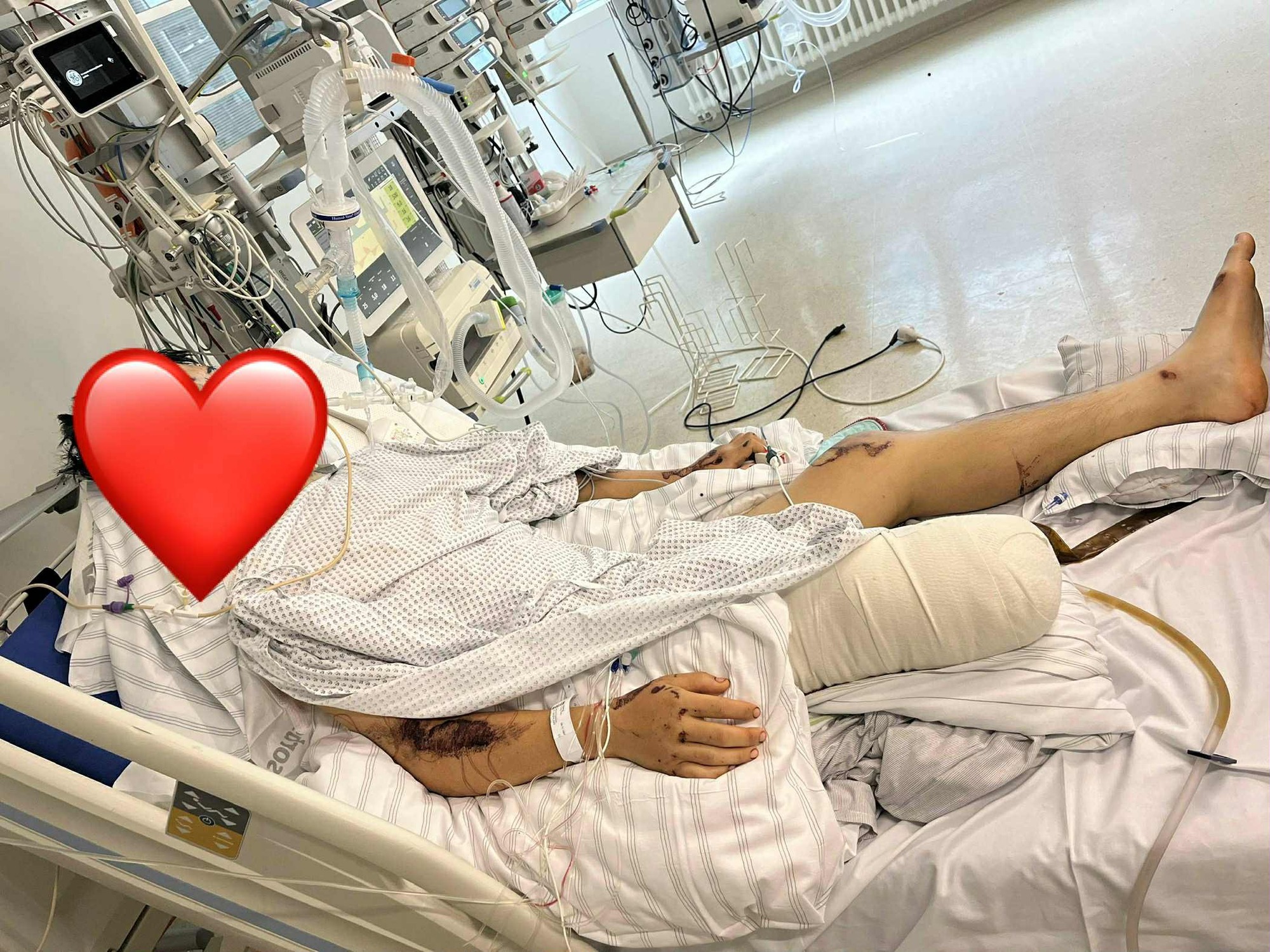 TikToker Bốp c&oacute; chia sẻ đầu ti&ecirc;n sau tai nạn nghi&ecirc;m trọng tại Đức, nhắc đến bạn g&aacute;i với th&aacute;i độ n&agrave;y- Ảnh 3.