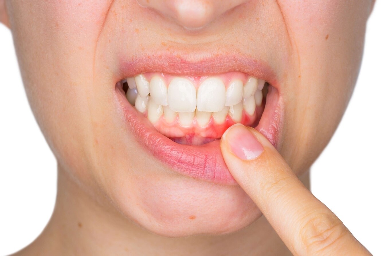 Cảnh báo: Nguy cơ đột quỵ tăng 86% ở những người có đặc điểm này ở miệng- Ảnh 1.
