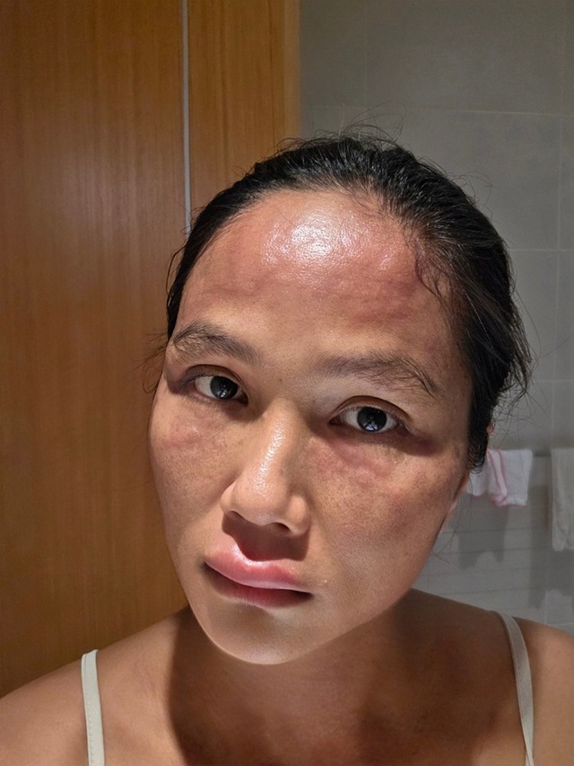 Hoa hậu H'Hen Niê sau khi bị biến dạng mặt - Ảnh 2. Hoa hậu H'Hen Niê sau khi bị biến dạng mặt - Ảnh 2.