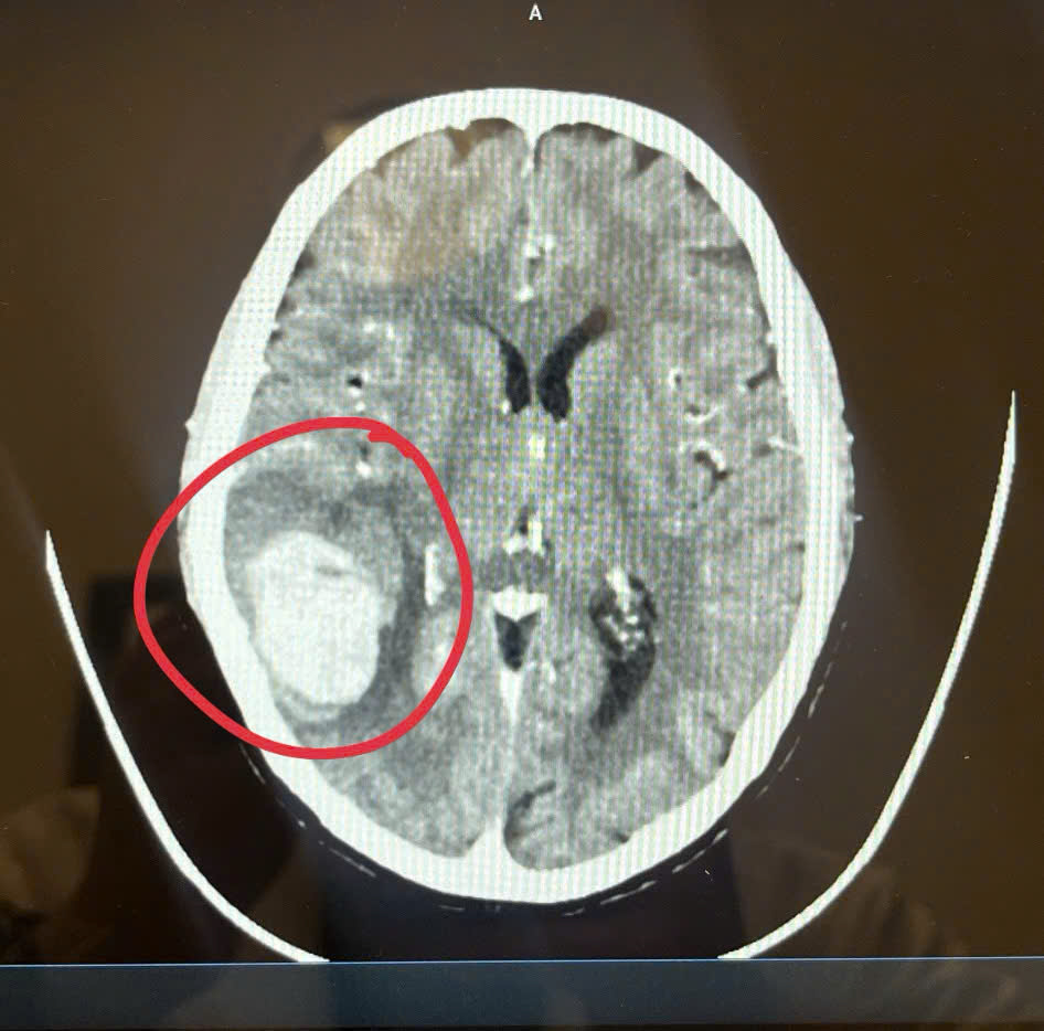 Phát hiện dấu hiệu lạ ở mặt khi đi chợ sớm, bệnh nhân làm ngay 1 việc khiến bác sĩ khen “quá sáng suốt”- Ảnh 1. Phát hiện dấu hiệu lạ ở mặt khi đi chợ sớm, bệnh nhân làm ngay 1 việc khiến bác sĩ khen “quá sáng suốt”- Ảnh 1.