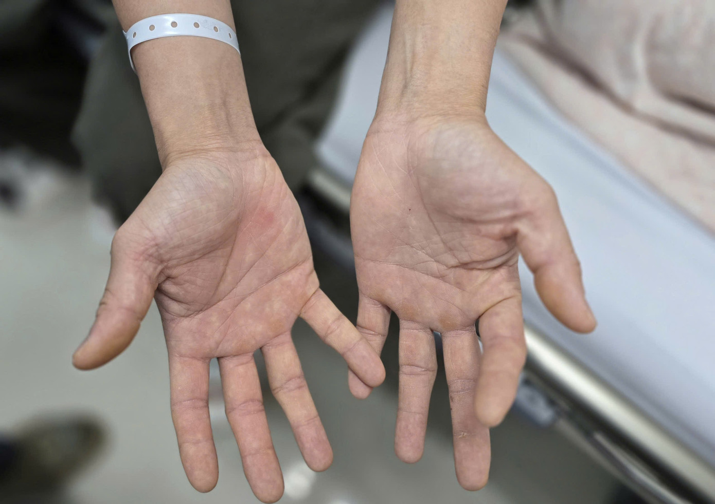 Mỗi ngày hít 240 đến 320 quả bóng cười, hai vợ chồng liệt, tổn thương tủy sống- Ảnh 2.