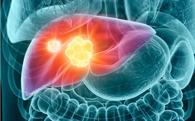 Những Triệu Chứng Sớm Nhất Của Ung Thư Gan - Biết Rõ Sẽ 