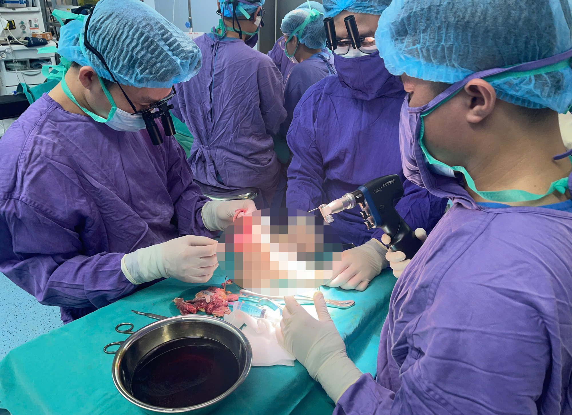 Nối chân đứt rời cho cô gái 19 tuổi sau va chạm với xe mô tô phân khối lớn- Ảnh 1. Nối chân đứt rời cho cô gái 19 tuổi sau va chạm với xe mô tô phân khối lớn- Ảnh 1.