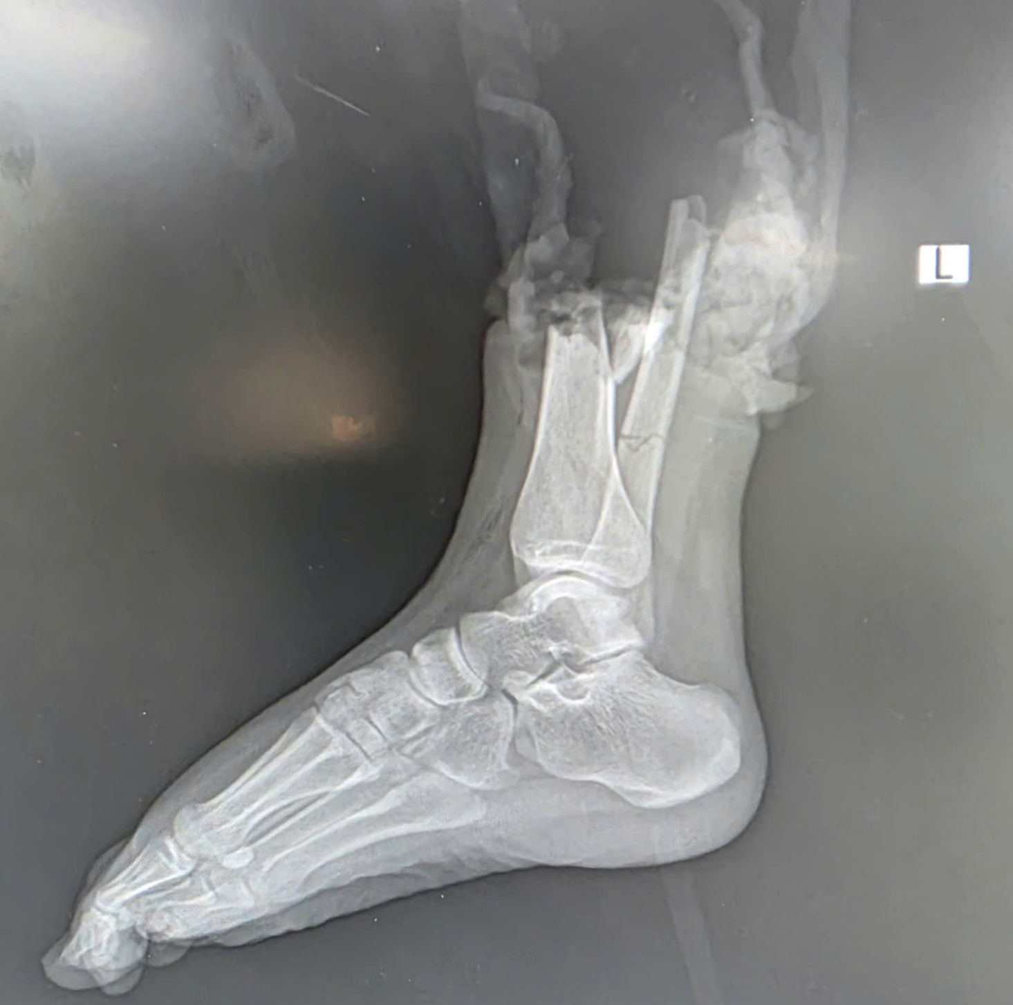 Nối chân đứt rời cho cô gái 19 tuổi sau va chạm với xe mô tô phân khối lớn- Ảnh 2. Nối chân đứt rời cho cô gái 19 tuổi sau va chạm với xe mô tô phân khối lớn- Ảnh 2.