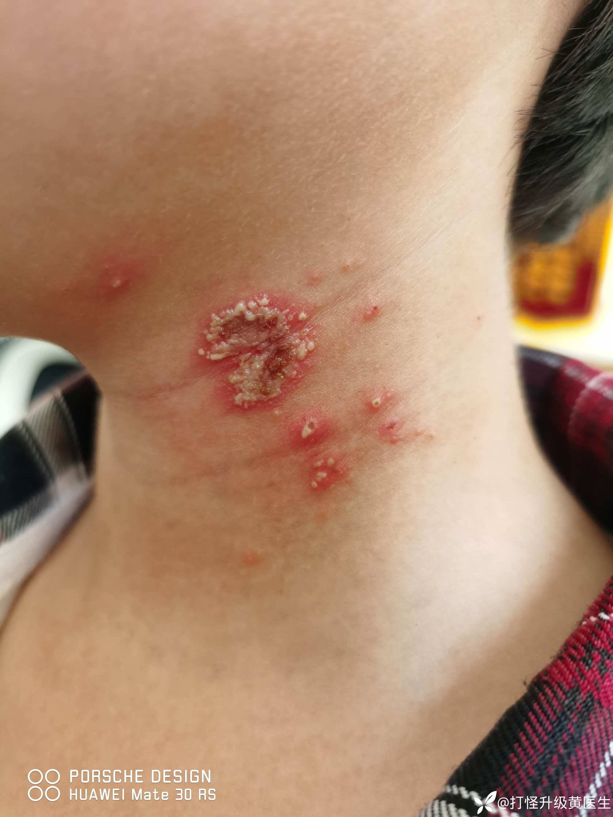 Bé trai 10 tuổi bỗng xuất hiện những nốt mẩn lạ trên da nhưng vẫn chưa tìm ra được nguyên nhân- Ảnh 2. Bé trai 10 tuổi bỗng xuất hiện những nốt mẩn lạ trên da nhưng vẫn chưa tìm ra được nguyên nhân- Ảnh 2.