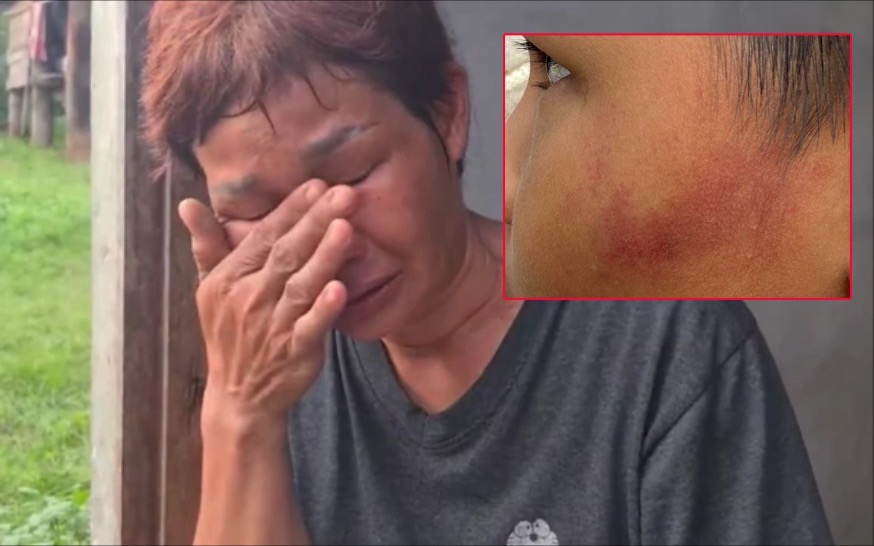 Bé trai 7 tuổi bị cô giáo dùng thước sắt đánh 14 lần vì ăn một viên kẹo- Ảnh 1.