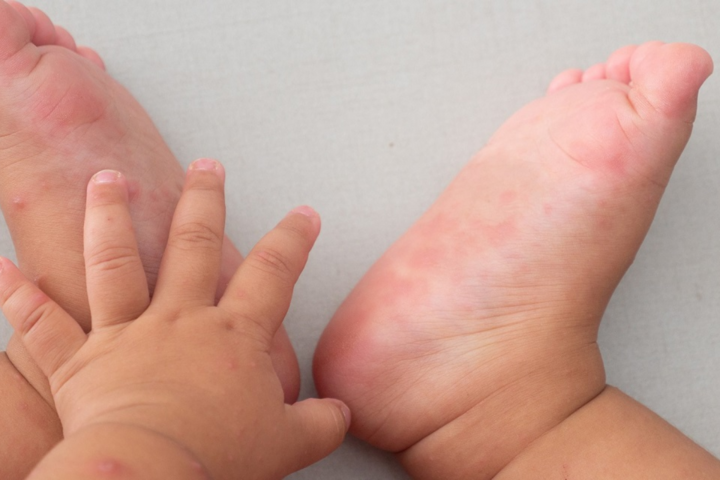 Bệnh Tay Chân Miệng Ở Trẻ Em: Dấu Hiệu, Nguyên Nhân Và Cách Điều Trị- Ảnh 1. Bệnh Tay Chân Miệng Ở Trẻ Em: Dấu Hiệu, Nguyên Nhân Và Cách Điều Trị- Ảnh 1.