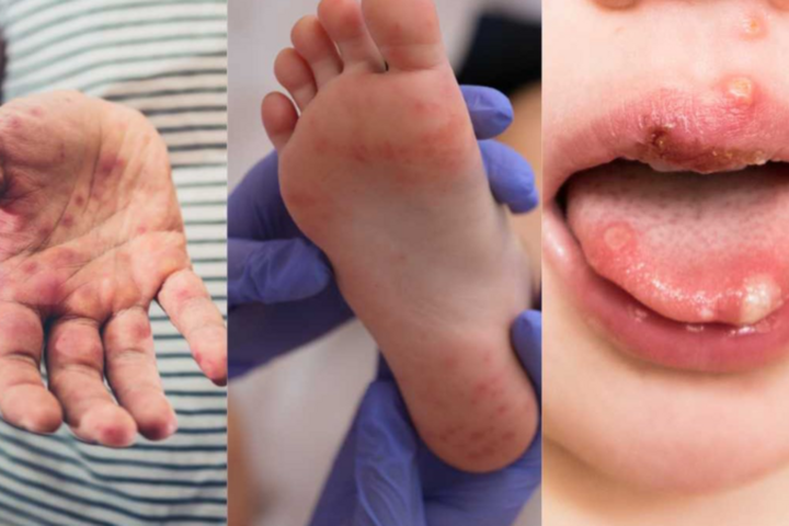 Bệnh Tay Chân Miệng Ở Trẻ Em: Dấu Hiệu, Nguyên Nhân Và Cách Điều Trị- Ảnh 2. Bệnh Tay Chân Miệng Ở Trẻ Em: Dấu Hiệu, Nguyên Nhân Và Cách Điều Trị- Ảnh 2.