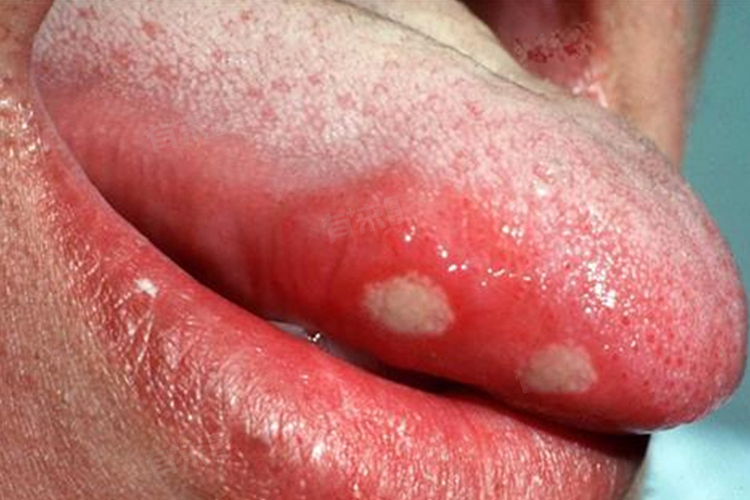 Bạn c&oacute; thể đ&atilde; trở th&agrave;nh "con mồi" của tế b&agrave;o ung thư nếu lưỡi xuất hiện 5 thay đổi- Ảnh 1.