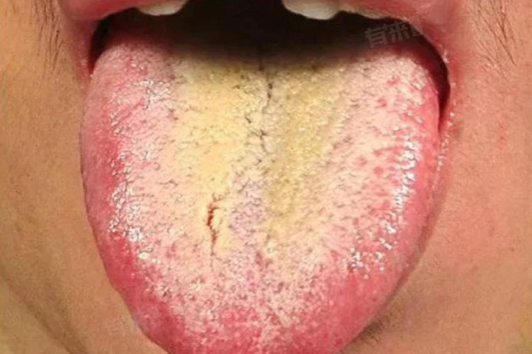 Bạn c&oacute; thể đ&atilde; trở th&agrave;nh "con mồi" của tế b&agrave;o ung thư nếu lưỡi xuất hiện 5 thay đổi- Ảnh 2.