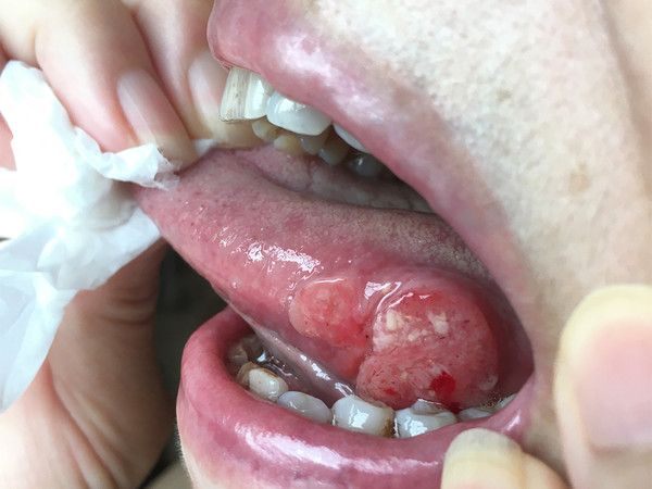 Bạn c&oacute; thể đ&atilde; trở th&agrave;nh "con mồi" của tế b&agrave;o ung thư nếu lưỡi xuất hiện 5 thay đổi- Ảnh 3.