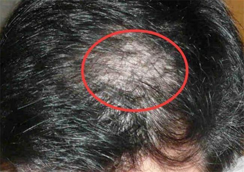 Nữ Sinh 14 Tuổi Rụng Sạch Tóc Vì Thói Quen Này Của Nhiều Người- Ảnh 1. Nữ Sinh 14 Tuổi Rụng Sạch Tóc Vì Thói Quen Này Của Nhiều Người- Ảnh 1.