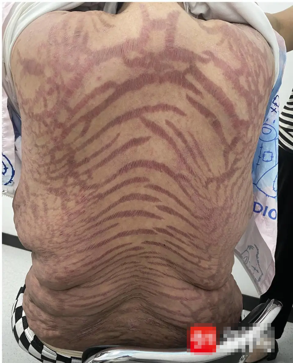 Da đầy vết rạn như da rắn v&igrave; thuốc mỡ b&ocirc;i da mua tr&ecirc;n mạng- Ảnh 1.