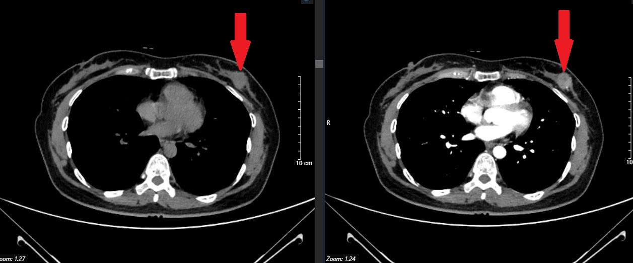 Đi khám cùng bạn "cho vui”, không ngờ phát hiện ung thư: Sốc vì không có bất cứ triệu chứng nào- Ảnh 1. Đi khám cùng bạn "cho vui”, không ngờ phát hiện ung thư: Sốc vì không có bất cứ triệu chứng nào- Ảnh 1.