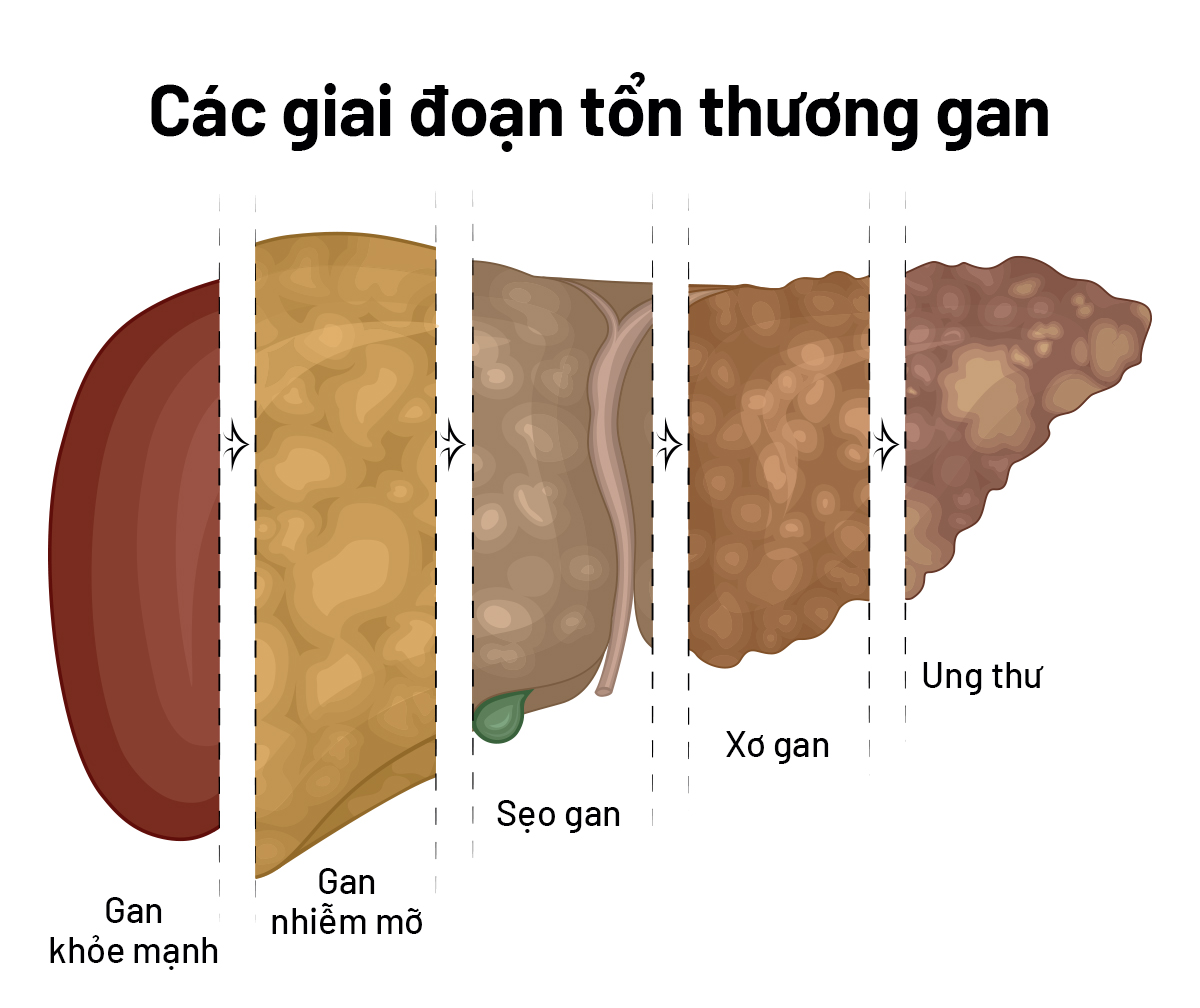 3 dấu hiệu sớm của ung thư gan nhưng dễ bị bỏ qua nhất- Ảnh 3. 3 dấu hiệu sớm của ung thư gan nhưng dễ bị bỏ qua nhất- Ảnh 3.