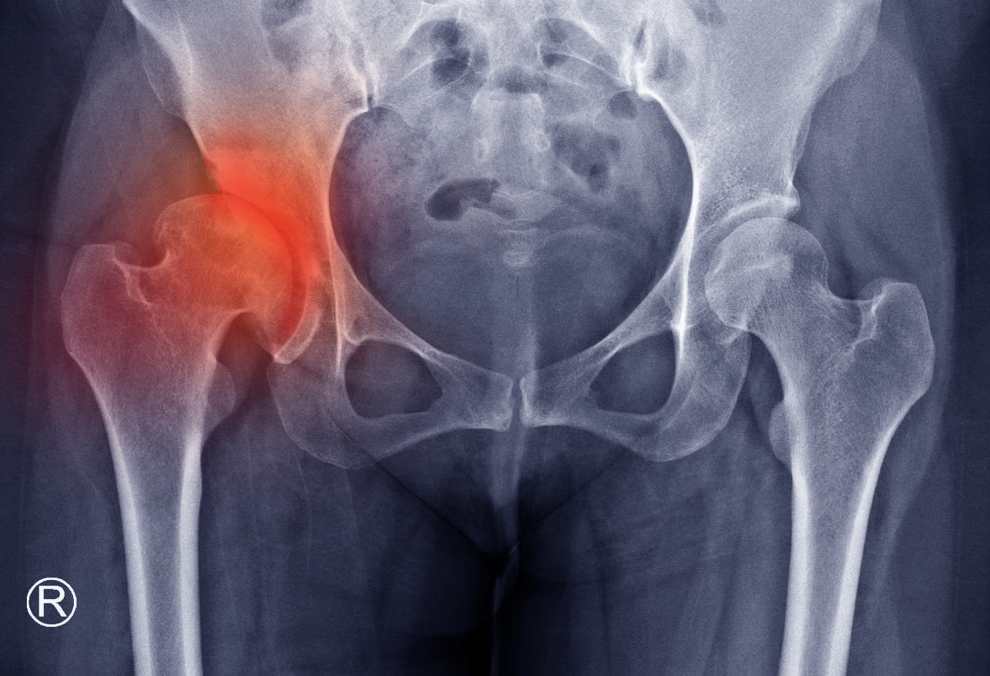 4 kiểu đau hông báo hiệu ung thư chồng chất: Nữ giới càng cần CẢNH GIÁC CAO- Ảnh 2.