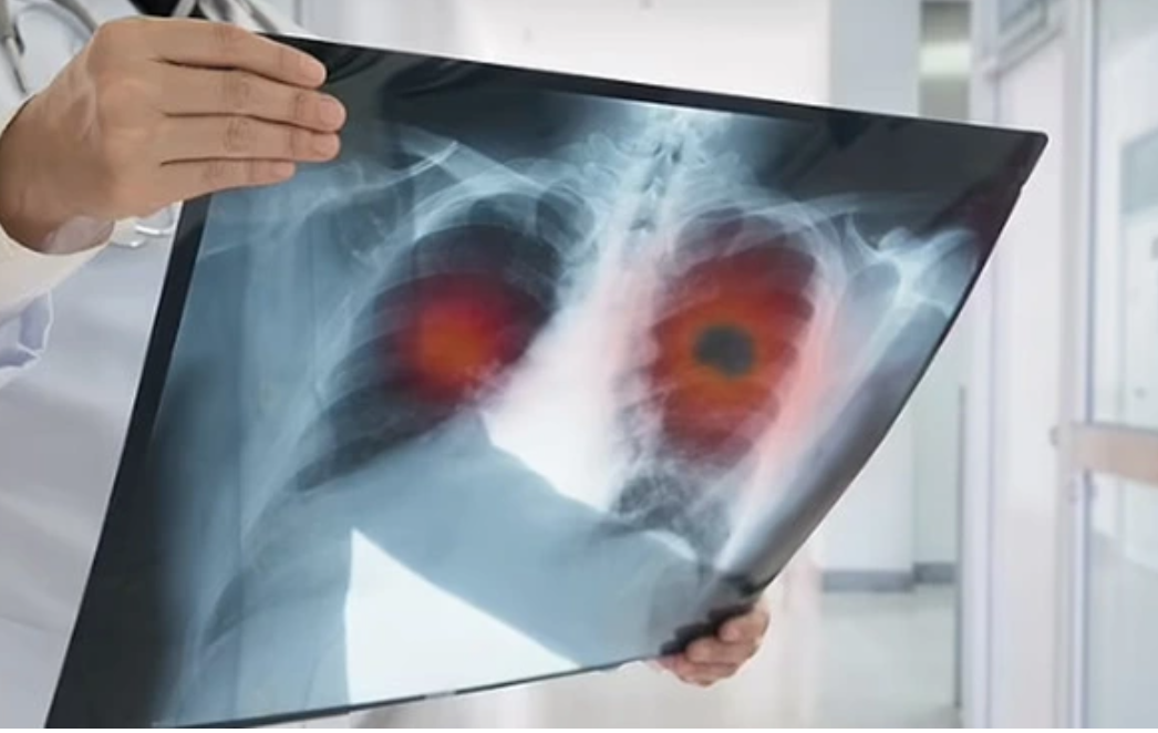 32 tuổi sống lành mạnh, sức khỏe tốt: Có 1 triệu chứng kéo dài 2 tuần, đi khám bỗng nhận kết quả K phổi- Ảnh 1.