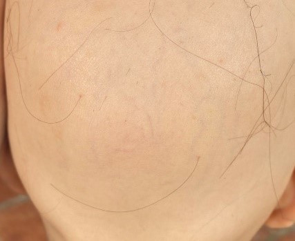 Điều trị thành công cho bệnh nhân 7 tuổi rụng toàn bộ tóc- Ảnh 1.