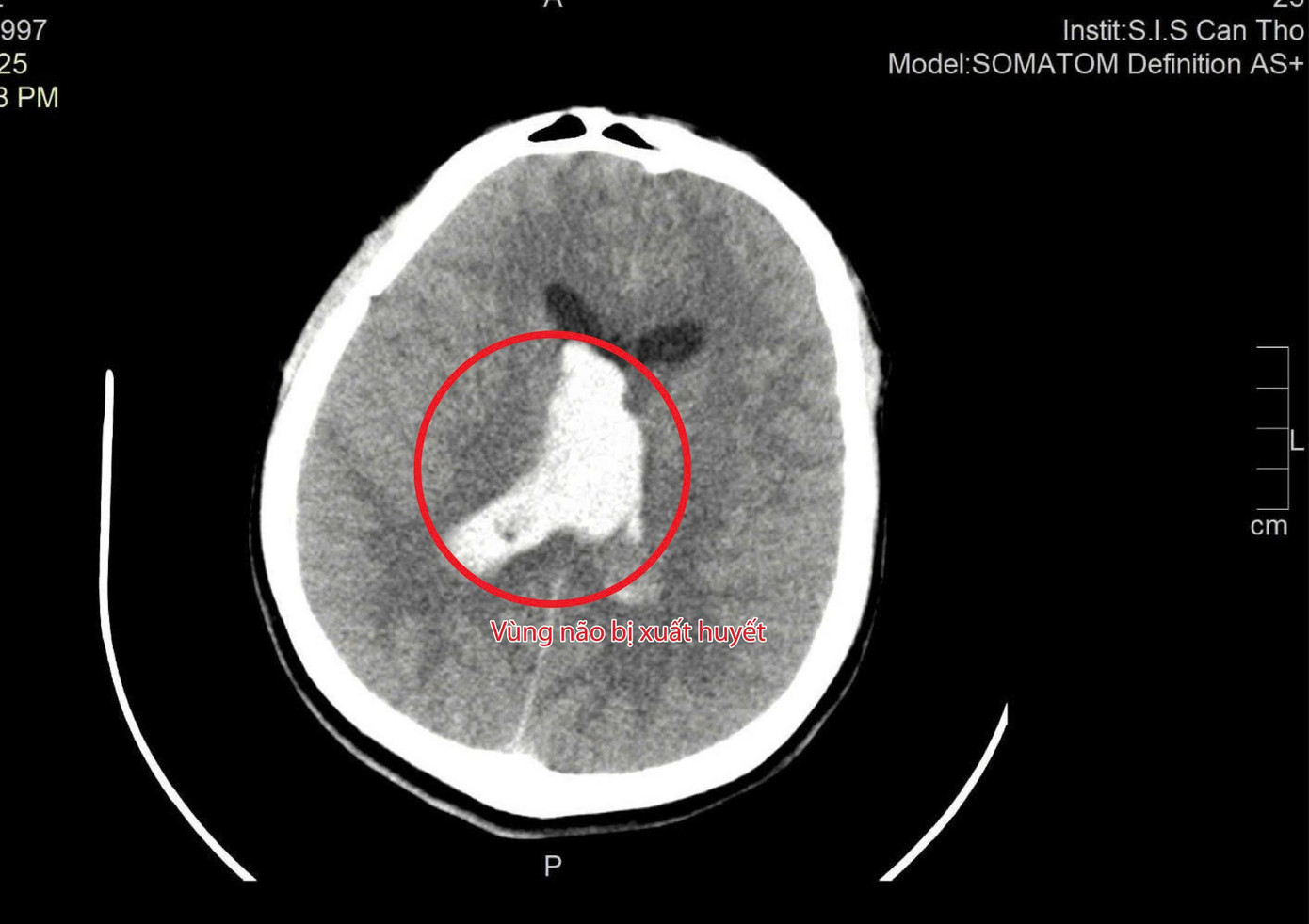 Thầy giáo trẻ bị đột quỵ - cảnh báo hiểm họa từ những dấu hiệu dễ bị bỏ qua- Ảnh 1.