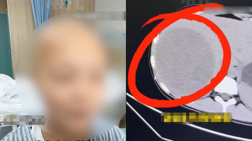 B&eacute; g&aacute;i 15 tuổi ph&aacute;t hiện khối u to bằng nửa l&aacute; gan, b&aacute;c sĩ tức giận: Ai lại coi m&oacute;n n&agrave;y l&agrave; bữa ch&iacute;nh!- Ảnh 1.