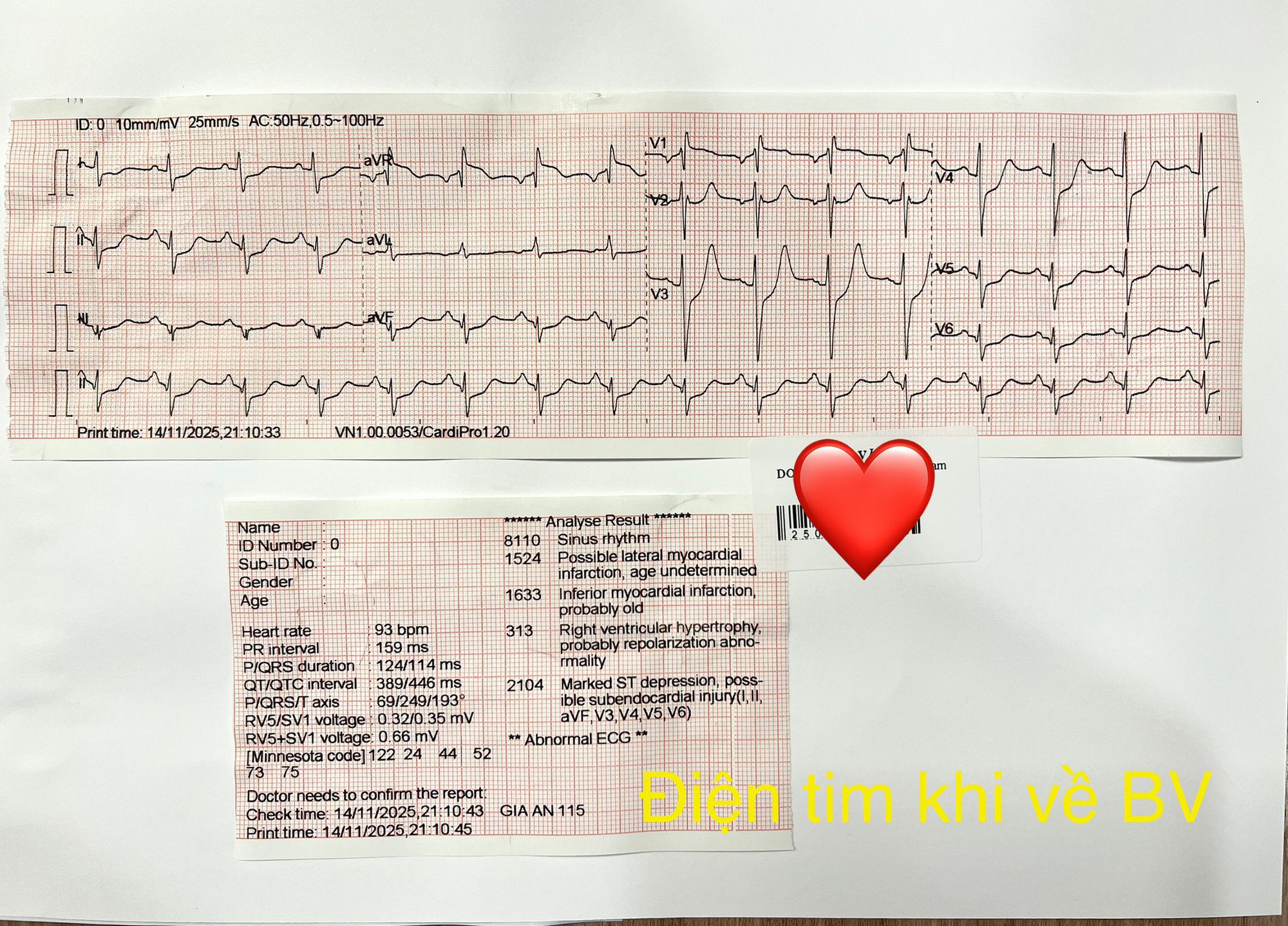 Người đàn ông 52 tuổi không qua khỏi vì người nhà dùng mẹo vắt chanh vào miệng khi hôn mê- Ảnh 3. Người đàn ông 52 tuổi không qua khỏi vì người nhà dùng mẹo vắt chanh vào miệng khi hôn mê- Ảnh 3.