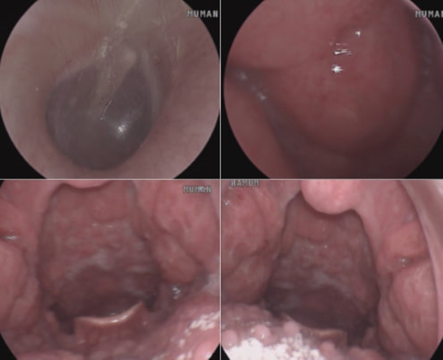 Chàng Trai 22 Tuổi Viêm Họng Chảy Máu Vì Quan Hệ Không An Toàn- Ảnh 1. Chàng Trai 22 Tuổi Viêm Họng Chảy Máu Vì Quan Hệ Không An Toàn- Ảnh 1.