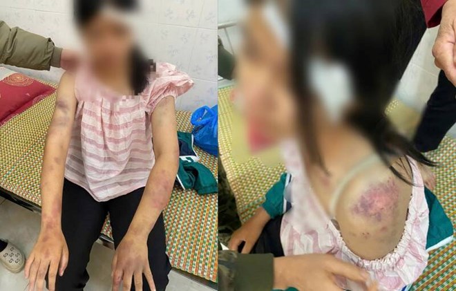 B&eacute; g&aacute;i 13 tuổi bị b&agrave; nội tra khảo, đ&aacute;nh đập d&atilde; man, người chi ch&iacute;t vết thương- Ảnh 1.