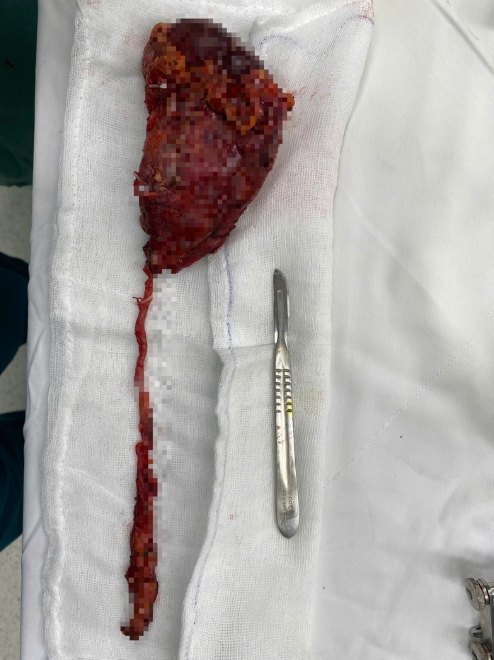 Đau lưng kéo dài, người đàn ông phát hiện 2 loại ung thư- Ảnh 2. Đau lưng kéo dài, người đàn ông phát hiện 2 loại ung thư- Ảnh 2.