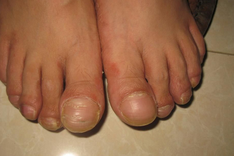 4 bất thường ở chân là dấu hiệu ung thư phổi dù nói ra có nhiều người CHẲNG CHỊU TIN!- Ảnh 2.