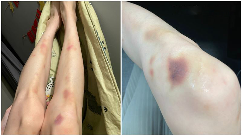 Một bất thường trên da đang cố TỐ CÁO ung thư máu nhưng lại bị đổ cho "đi đứng vụng về"- Ảnh 1.