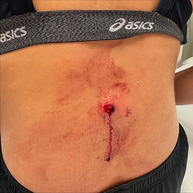 Nữ thần bóng chuyền thoát chết thần kì sau khi bị bắn trúng trong một vụ cướp- Ảnh 2.