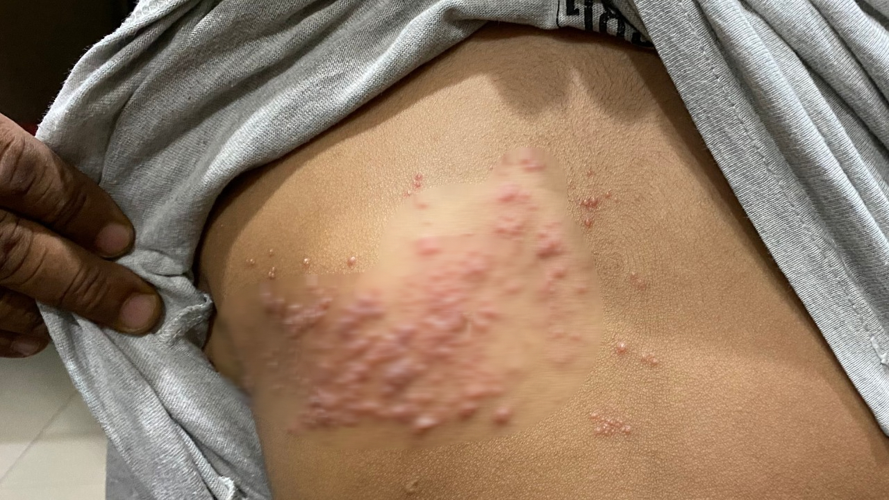 Cô Gái 27 Tuổi Nhiễm Virus Herpes Sau Khi Mở Gói Hàng Mua Qua Mạng- Ảnh 3.